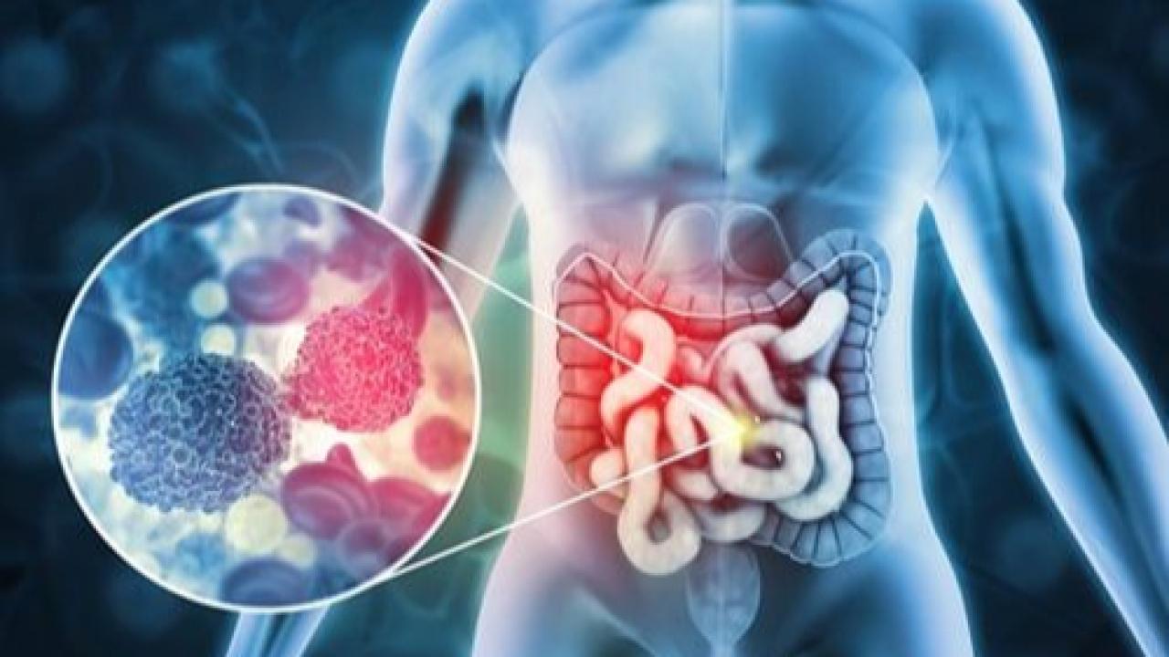 Afyon’da 39 Bin Kişiye Kolorektal Kanser Taraması Yapıldı