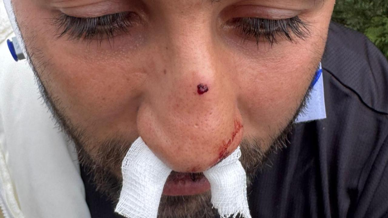 Afyon’da Amatör Maçta Skandal: Futbolcunun Burnu 3 Yerinden Kırıldı!